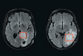 Image: Using MR spectroscopy, a team of researchers has developed a way to measure whether brain tumors have a mutation in a gene called IDH. The tissue being analyzed is inside the red boxes. The tumor on the left has the mutation, while the tumor on the right does not (Photo courtesy of MIT).